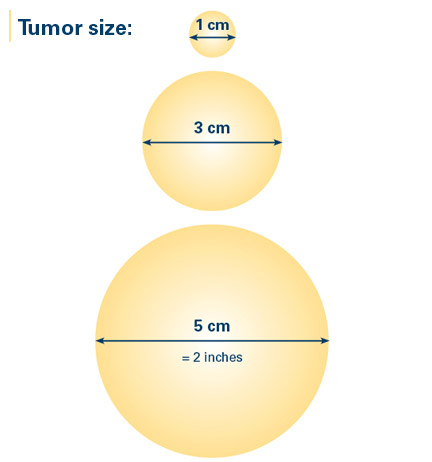 Size of the Breast Cancer 177272
