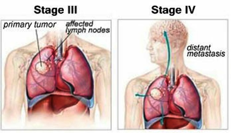 Stage 4 Cancer Lung 172772