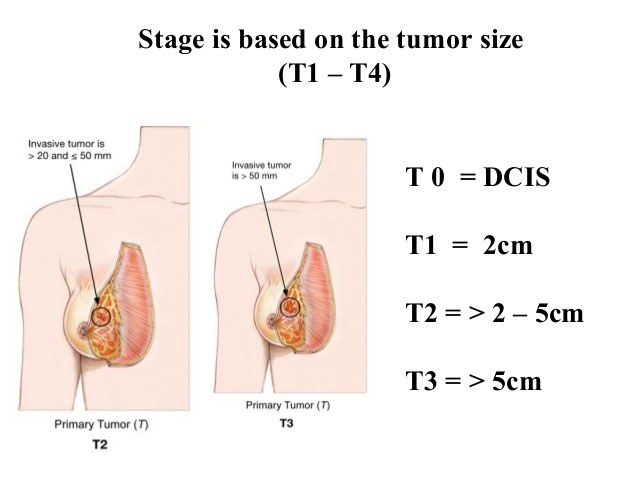Stage Is Based On The Tumor Size 182882