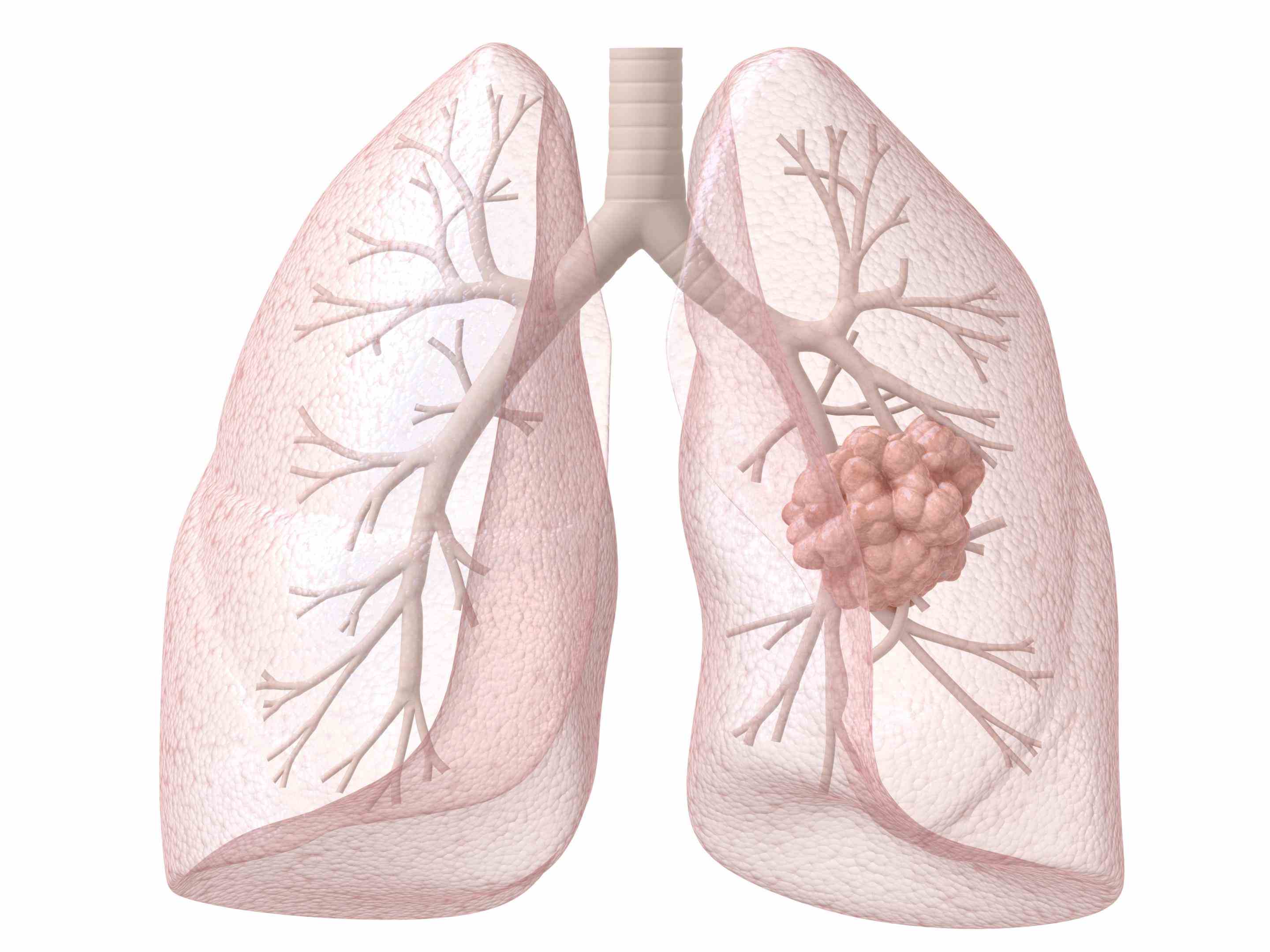 The Lung about lung cancer symptoms stages treatment life