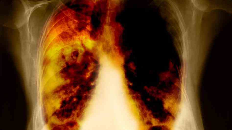 The Lung cancer is one of the most common