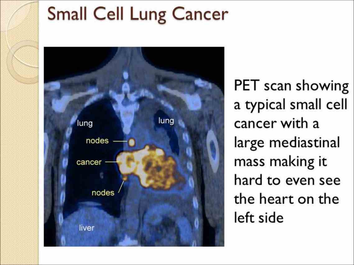 Small Cell Cancer Lung Pictures Wallpapers