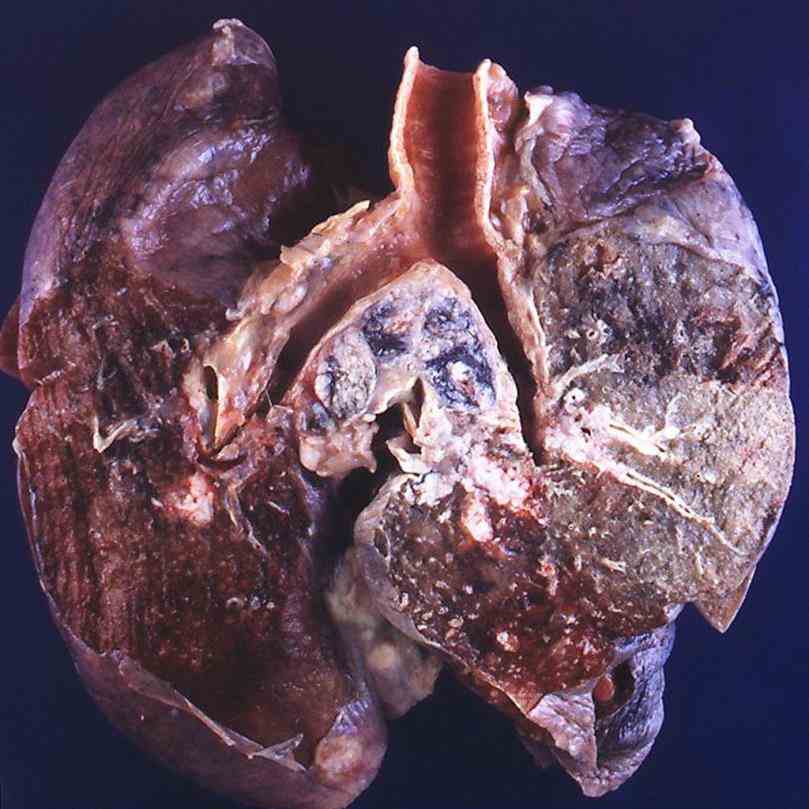 Small Cell Cancer Lung Pictures Wallpapers