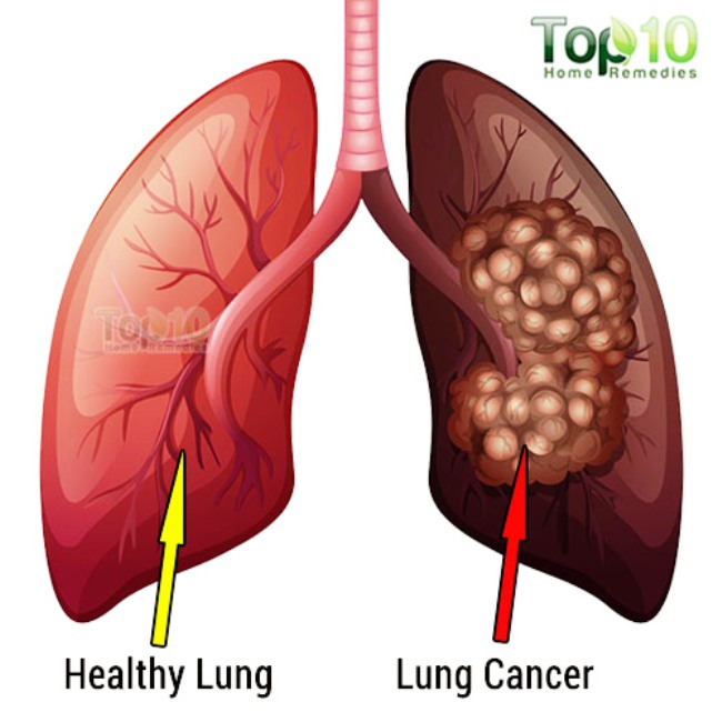 lung cancer vs normal lung