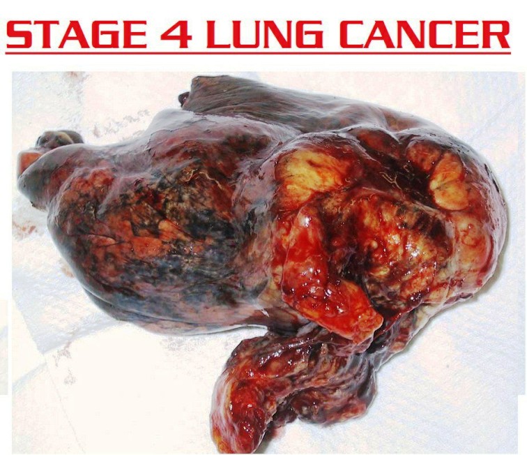 stage 4 lung cancer 118288