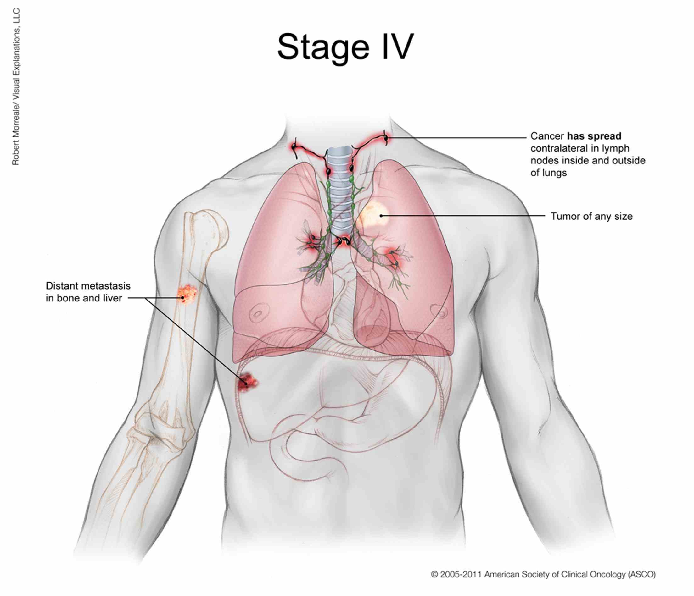 what Stage 4 Cancer Lung is stage lung