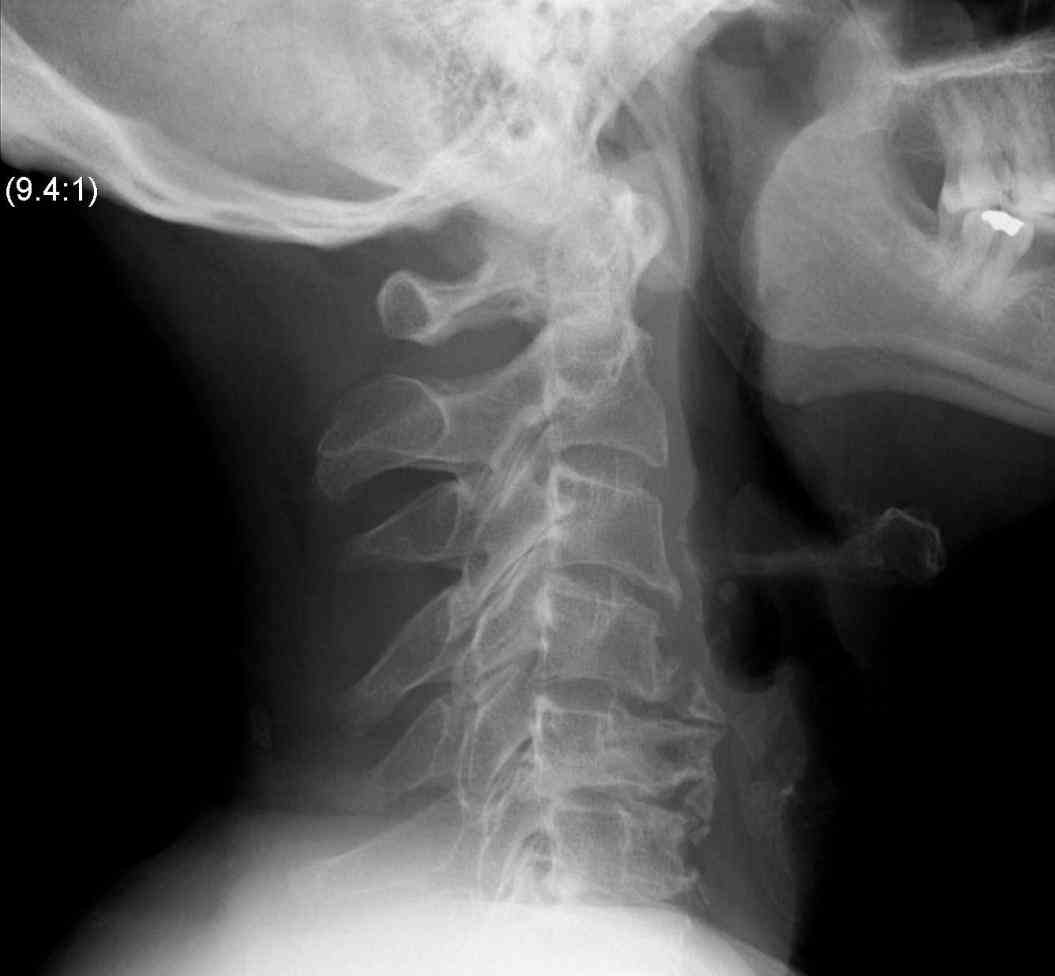 secondary to exaggerated flexion or extension because of direct trauma axial loading pathology the is  cervical C Spine spine