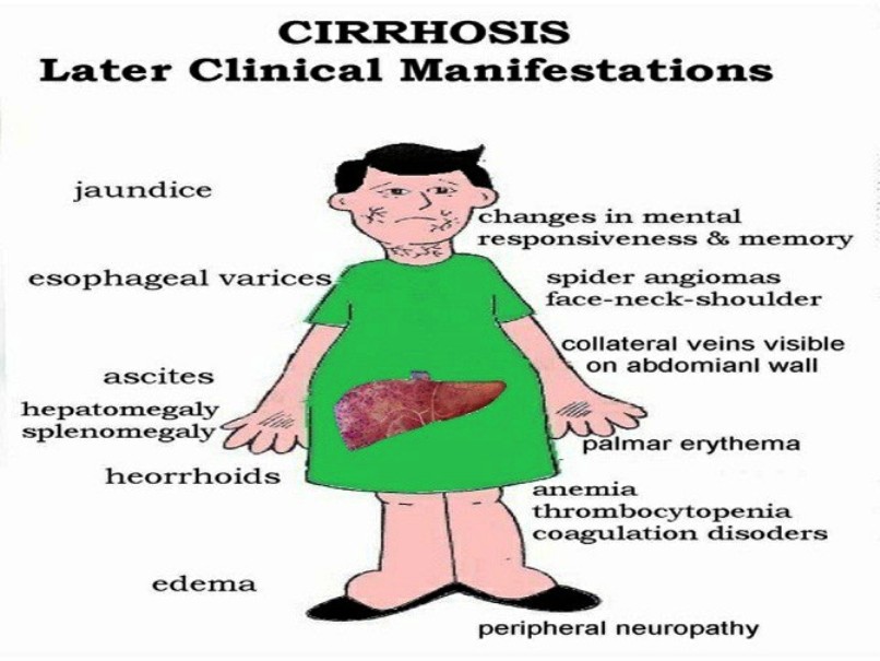 Complications of Cirrhosis Pictures Wallpapers