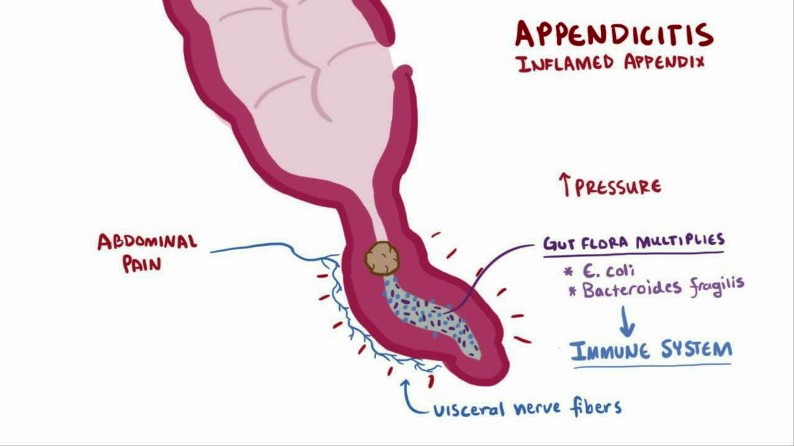 Overview of Appendicitis Pictures Wallpapers