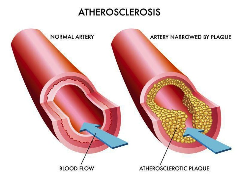 Photo Of Arteriosclerosis Pictures Wallpapers