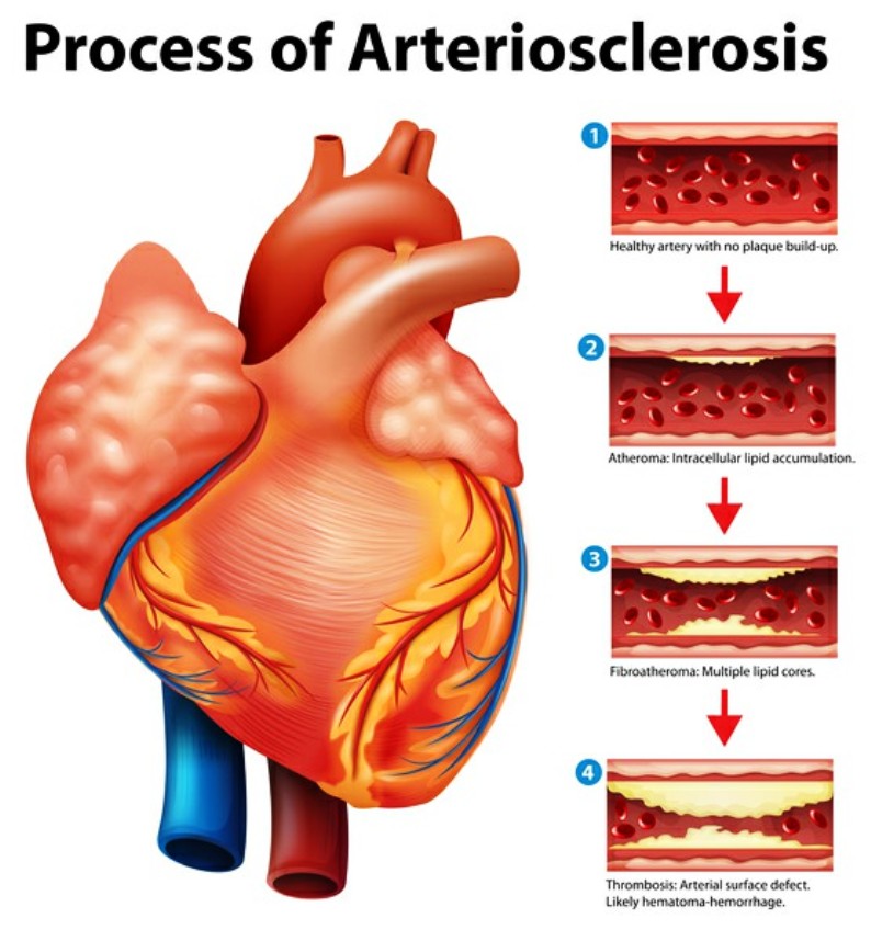 Process of Arteriosclerosis Pictures Wallpapers