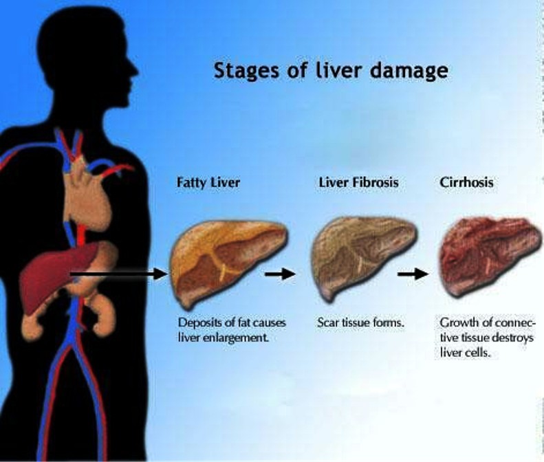 Stages Of Liver Damage