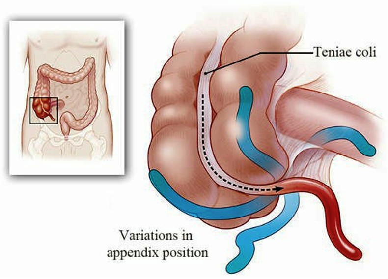 Variations in Appendix Position